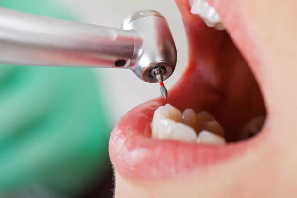 Tooth Infection Emergency Dentist in TX